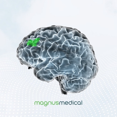 Magnus Medical brain image rendering highlighting SAINT